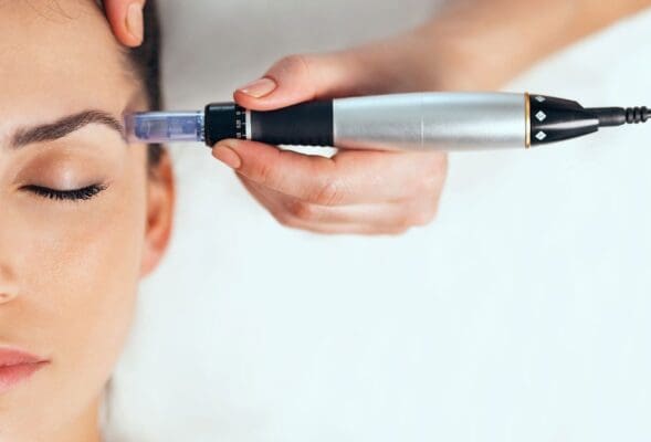 microneedling